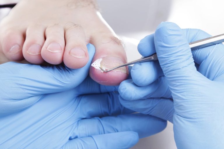 From Pain to Relief: Your Guide to Ingrown Toenail Removal in San Antonio